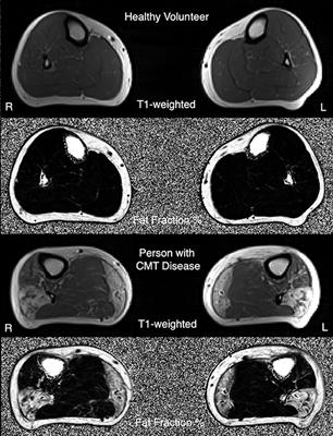 Accelerate Clinical Trials in Charcot-Marie-Tooth Disease (ACT-CMT): A Protocol to Address Clinical Trial Readiness in CMT1A